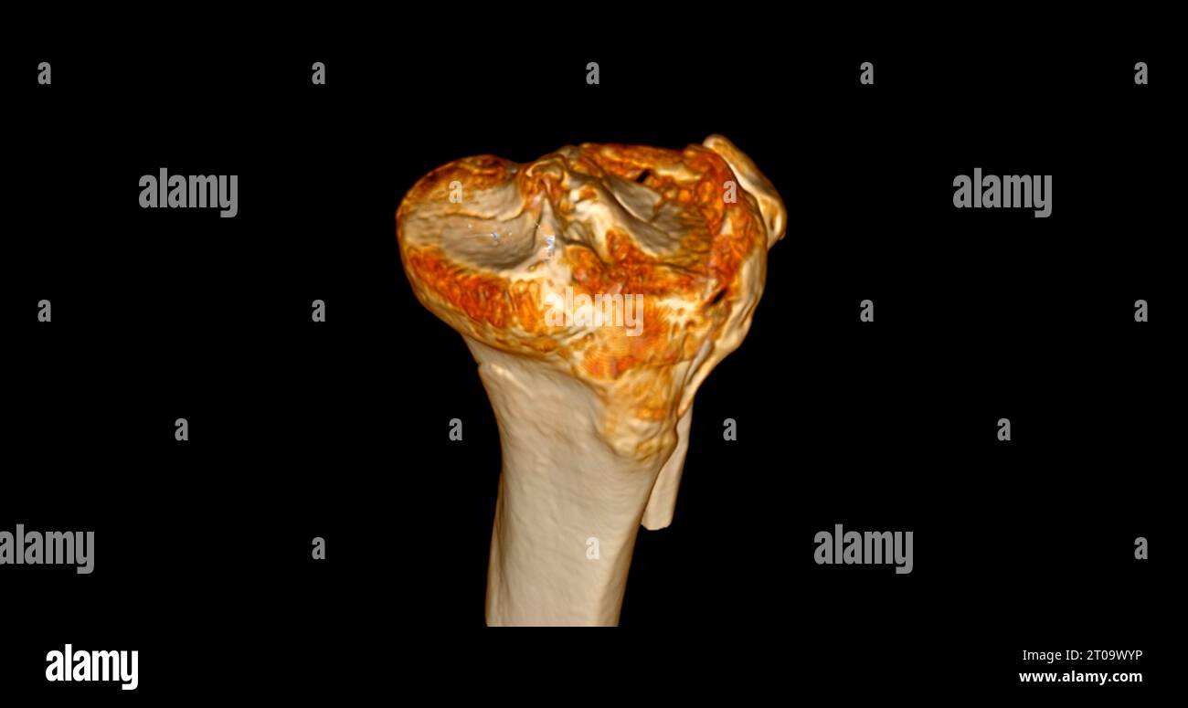 CT Scan of Knee joint showing fracture tibia and fibula bone 3D ...