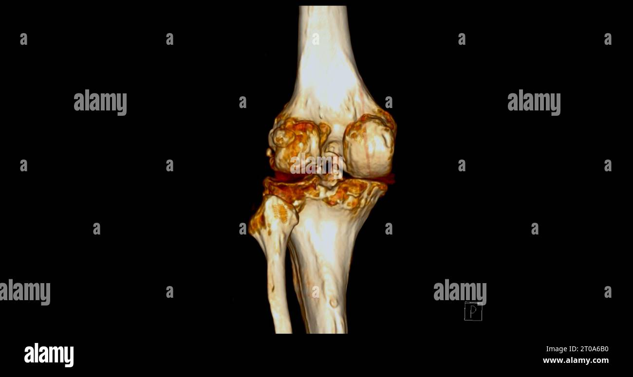 CT Scan of Knee joint showing fracture tibia and fibula bone 3D ...