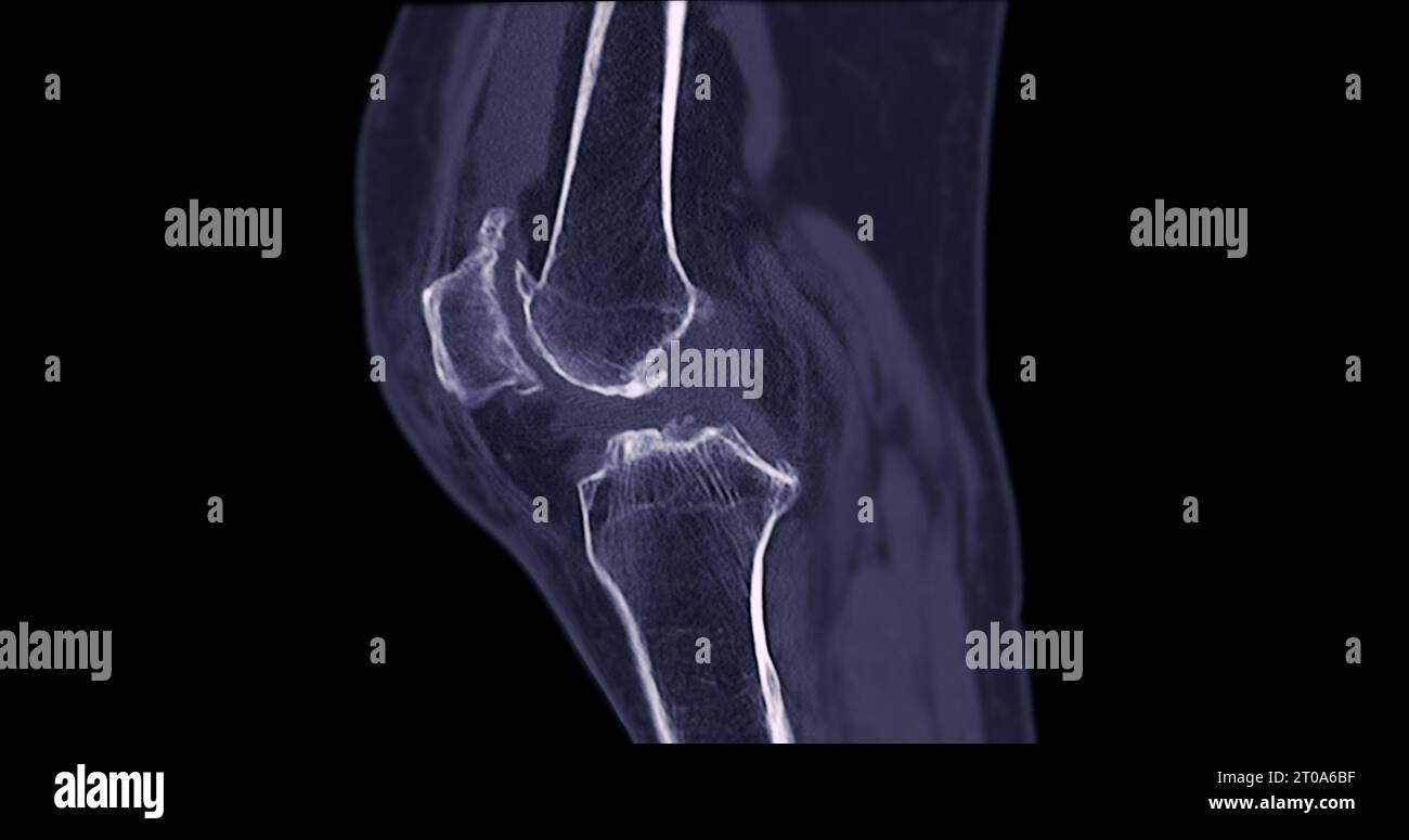 CT Scan of Knee joint for medical background Stock Photo - Alamy