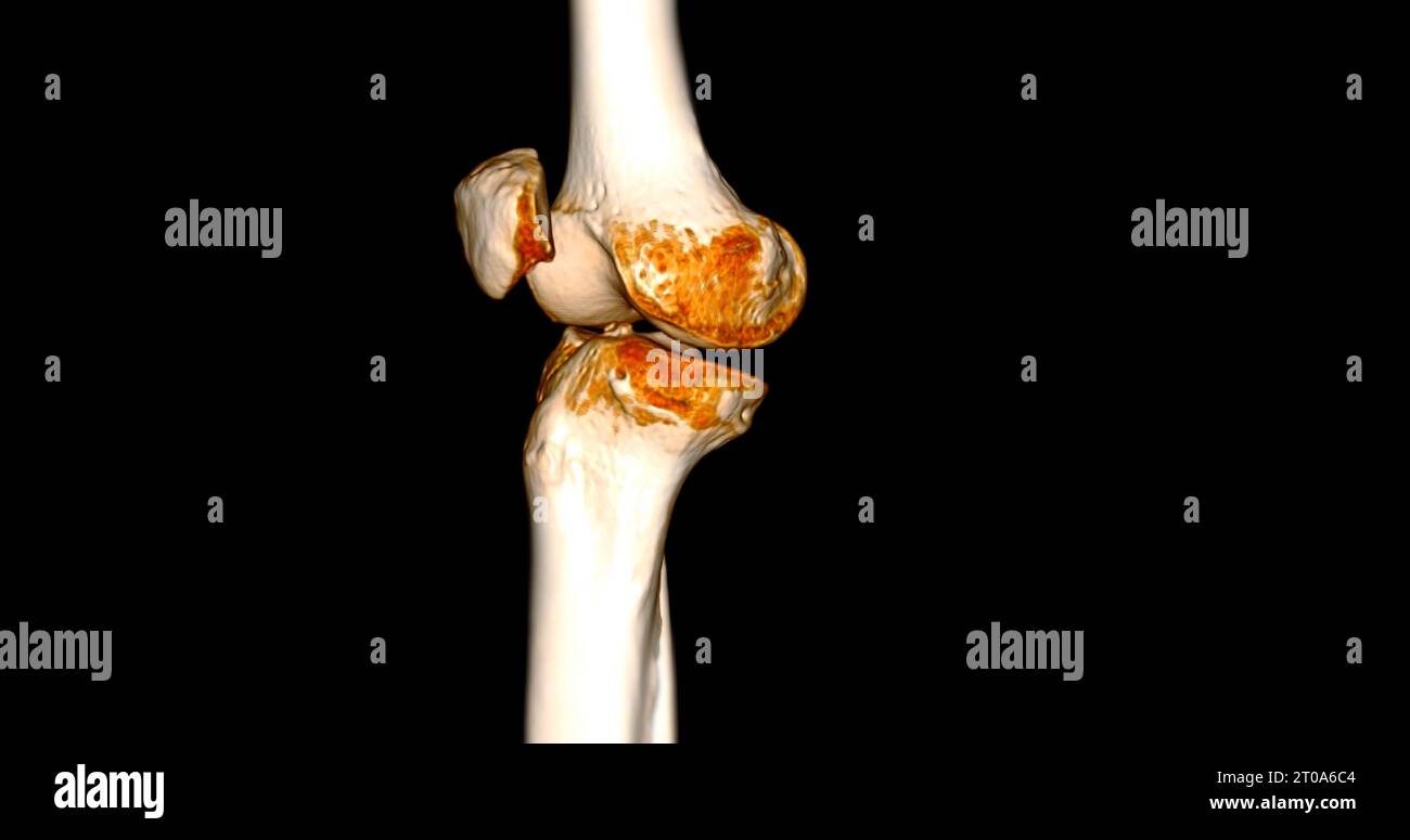 CT Scan of Knee joint showing fracture tibia and fibula bone 3D ...