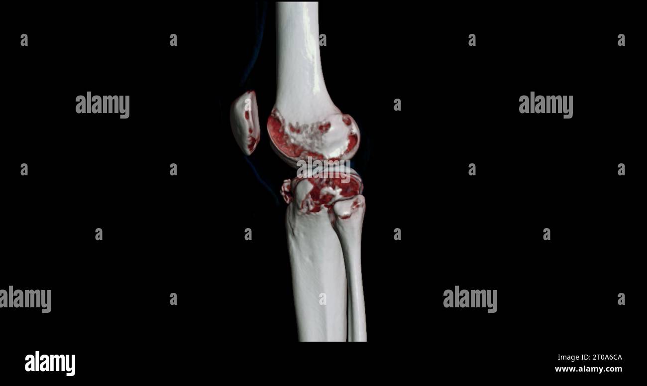 CT Scan of Knee joint showing fracture tibia and fibula bone 3D ...