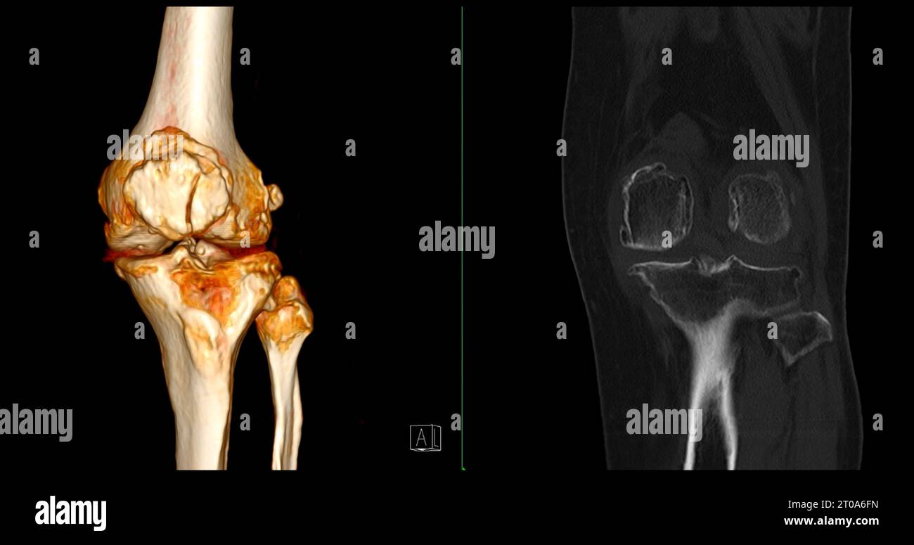 CT Scan of Knee joint showing fracture tibia and fibula bone 3D ...