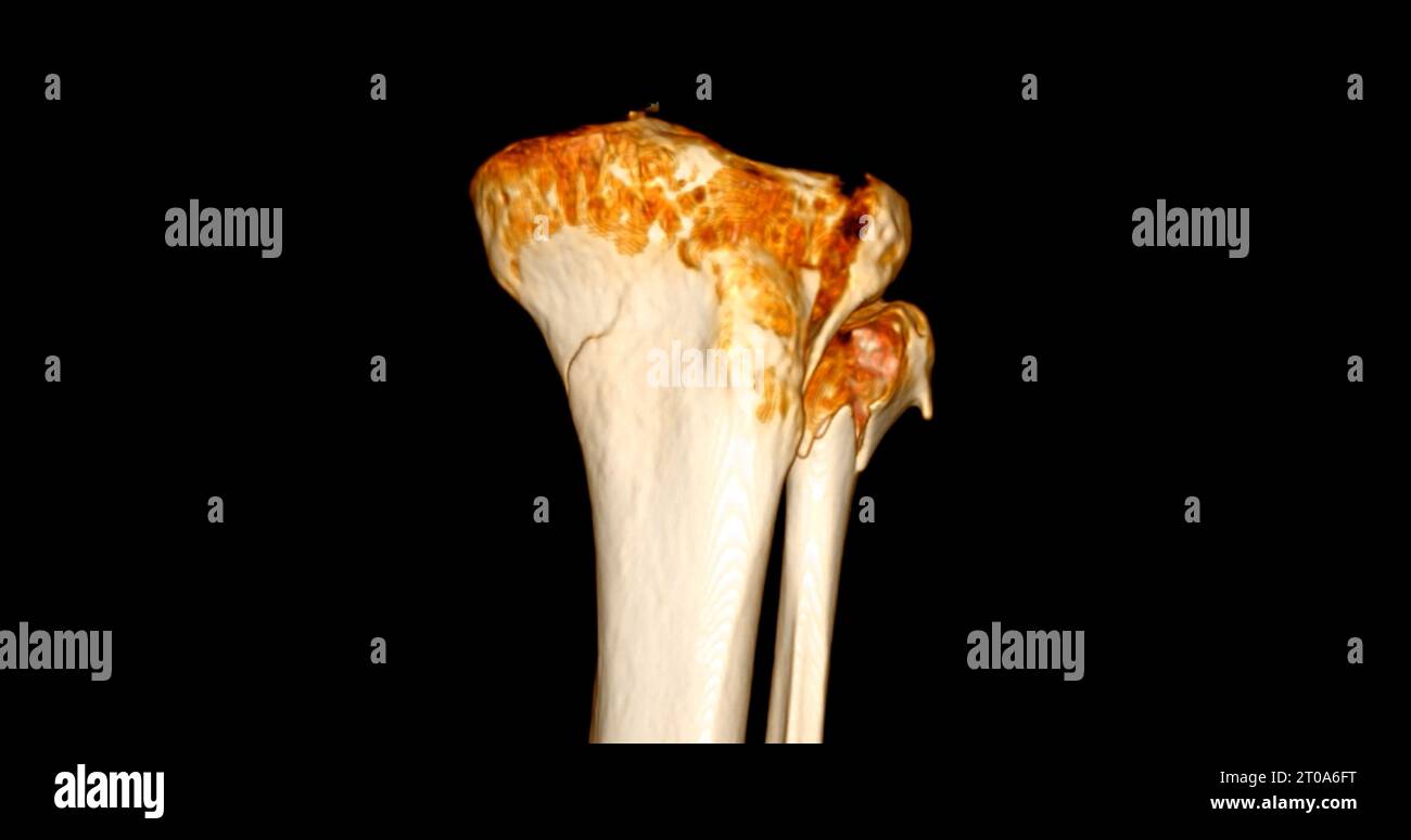 CT Scan of Knee joint showing fracture tibia and fibula bone 3D ...