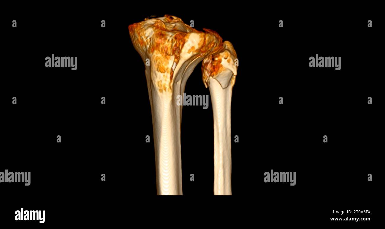 In the tibia hi-res stock photography and images - Alamy