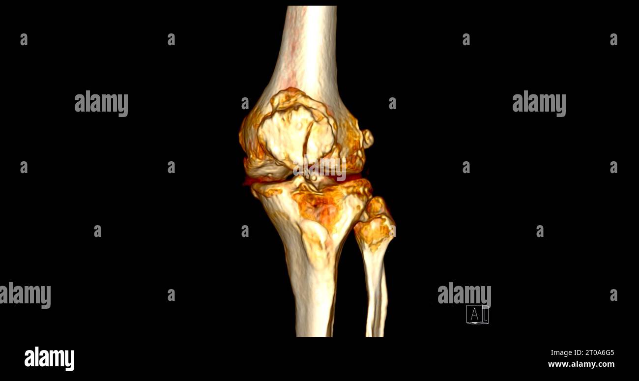 CT Scan of Knee joint showing fracture tibia and fibula bone 3D ...