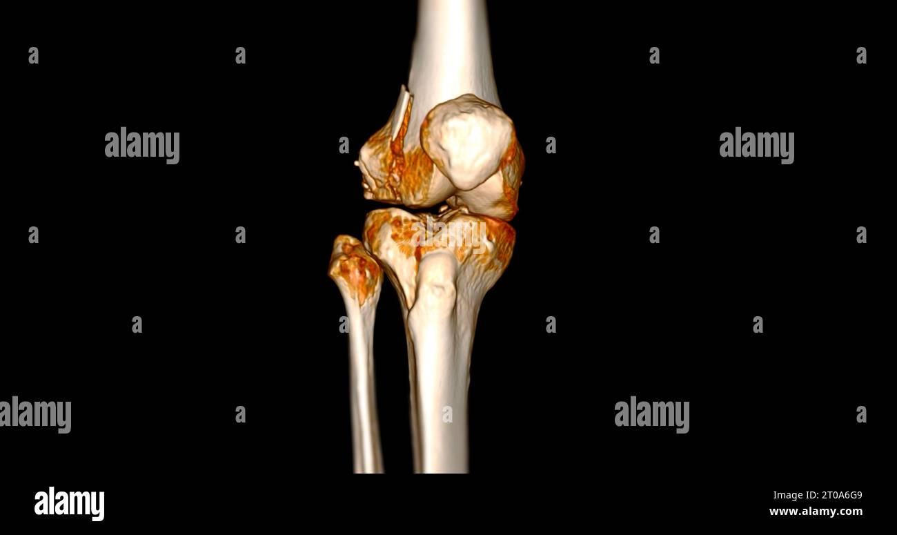 CT Scan of Knee joint showing fracture tibia and fibula bone 3D ...