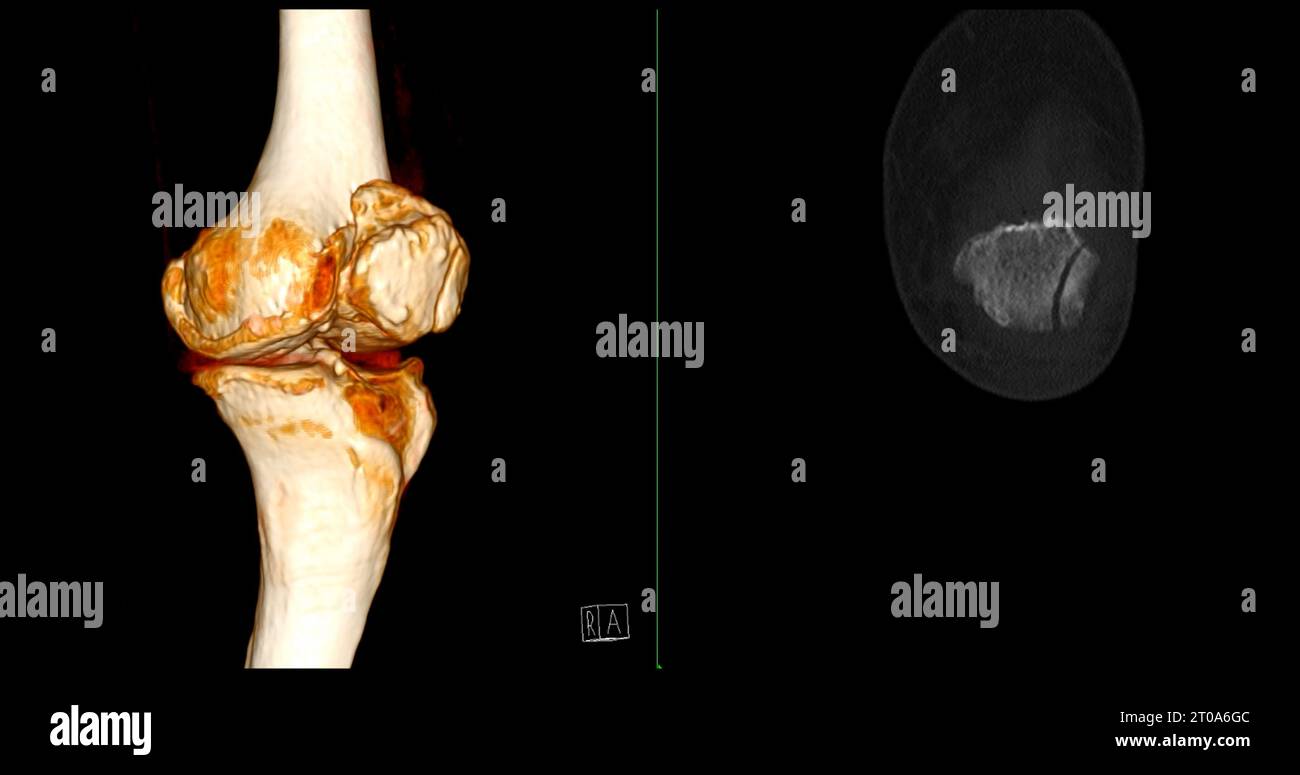 CT Scan of Knee joint showing fracture tibia and fibula bone 3D ...
