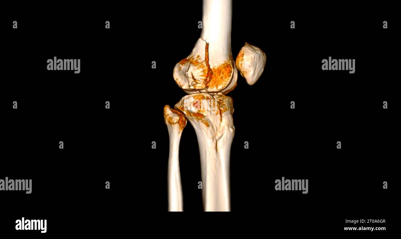 CT Scan of Knee joint showing fracture tibia and fibula bone 3D ...
