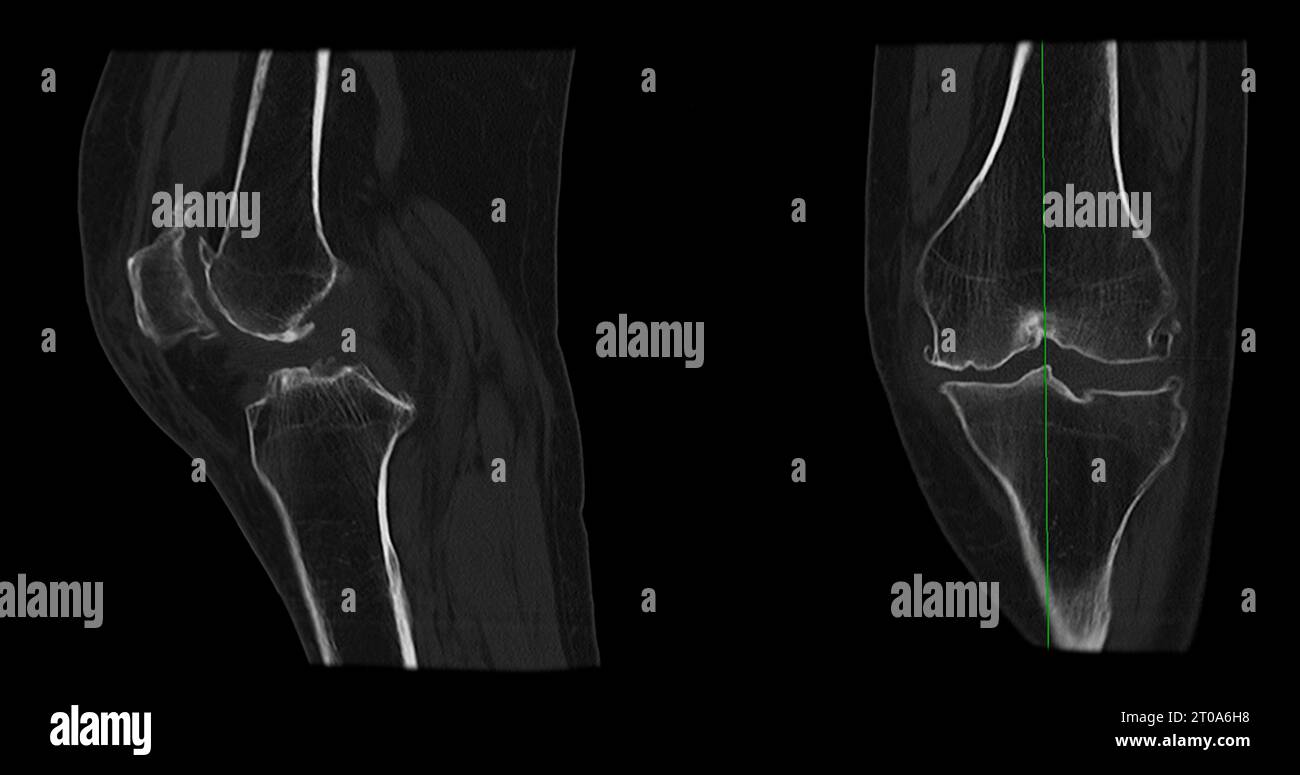 Ct Scan Of Knee Joint Sagittal And Coronal In Case Fracture Patella 