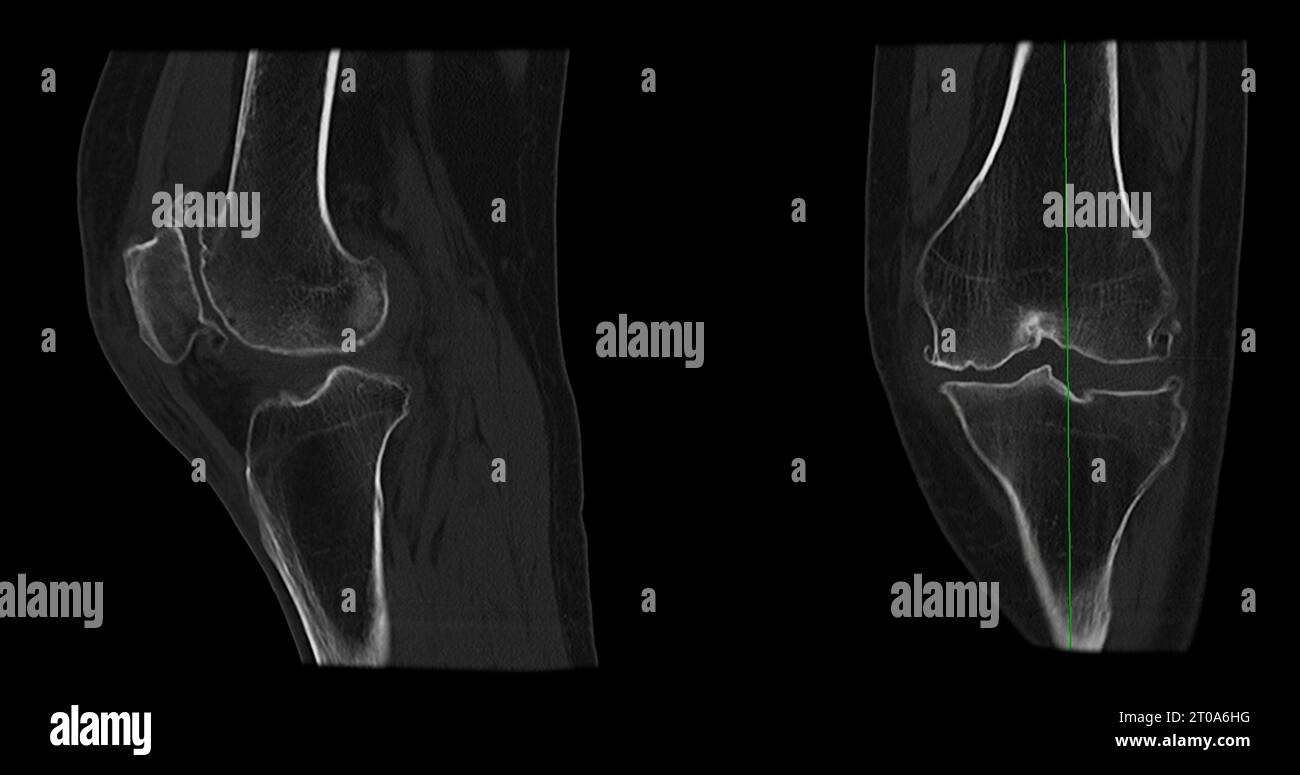 CT Scan of Knee joint sagittal and coronal in case fracture patella