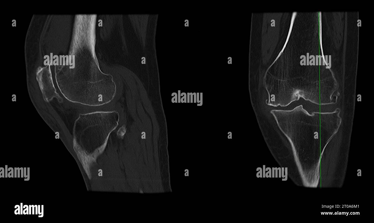 Ct Scan Of Knee Joint Sagittal And Coronal In Case Fracture Patella 