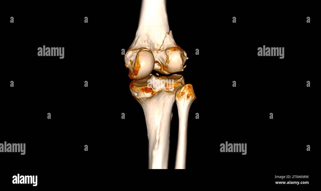CT Scan of Knee joint showing fracture tibia and fibula bone 3D ...