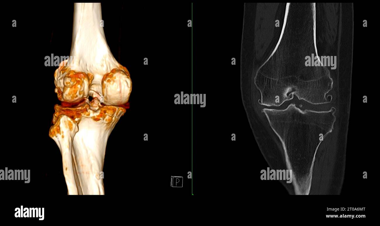 CT Scan of Knee joint showing fracture tibia and fibula bone 3D ...