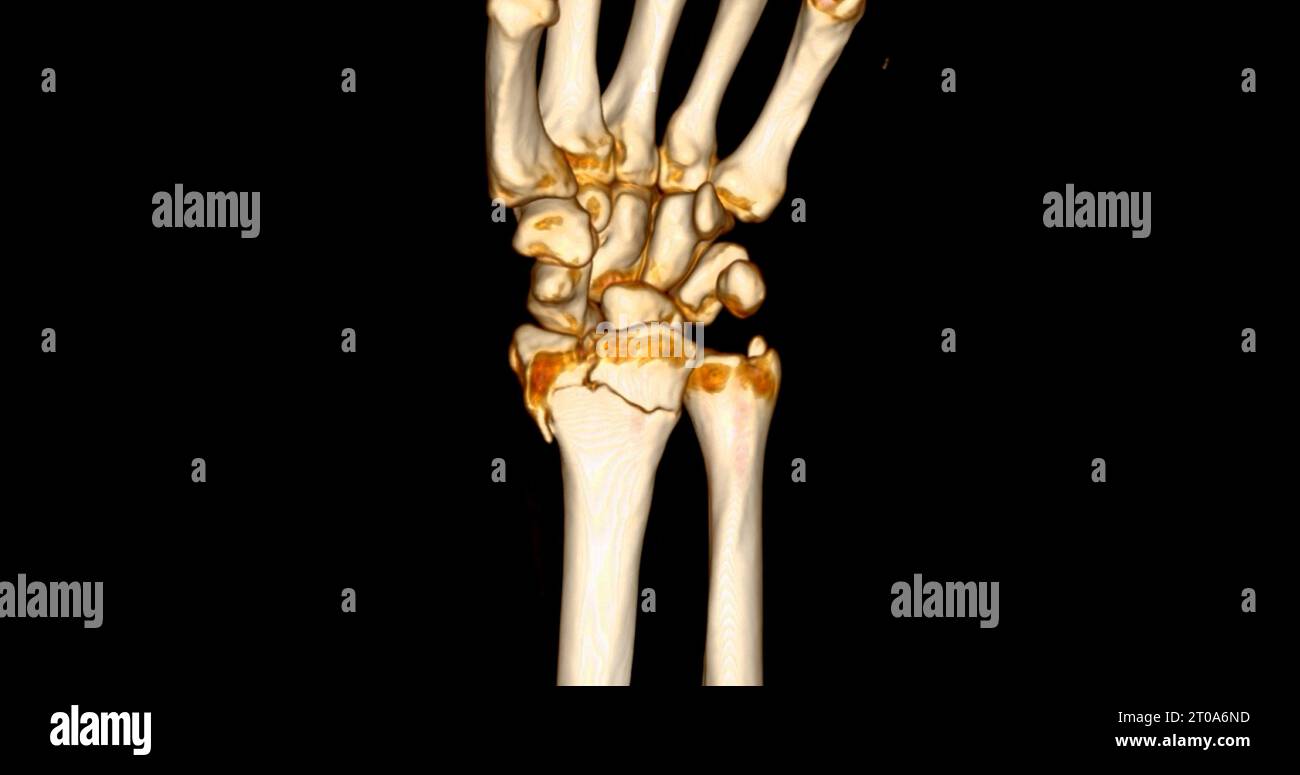CT scan of wrist joint 3D rendering for diagnosis wrist joint pain Stock Photo Alamy