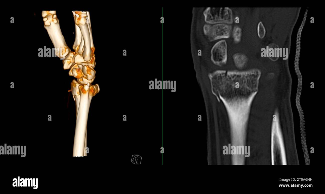 CT scan of wrist joint 3D rendering for diagnosis wrist joint pain. Stock Photo