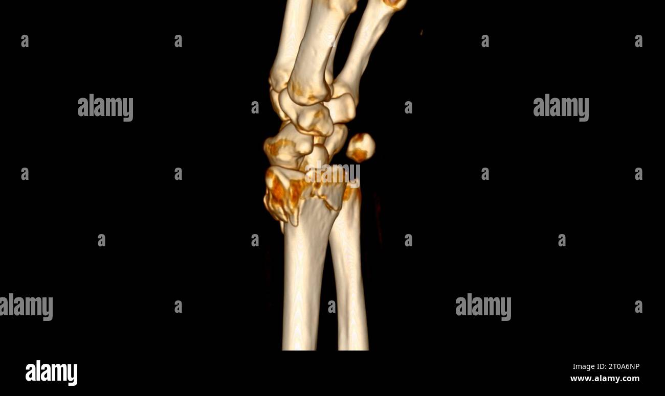 CT scan of wrist joint 3D rendering for diagnosis wrist joint pain