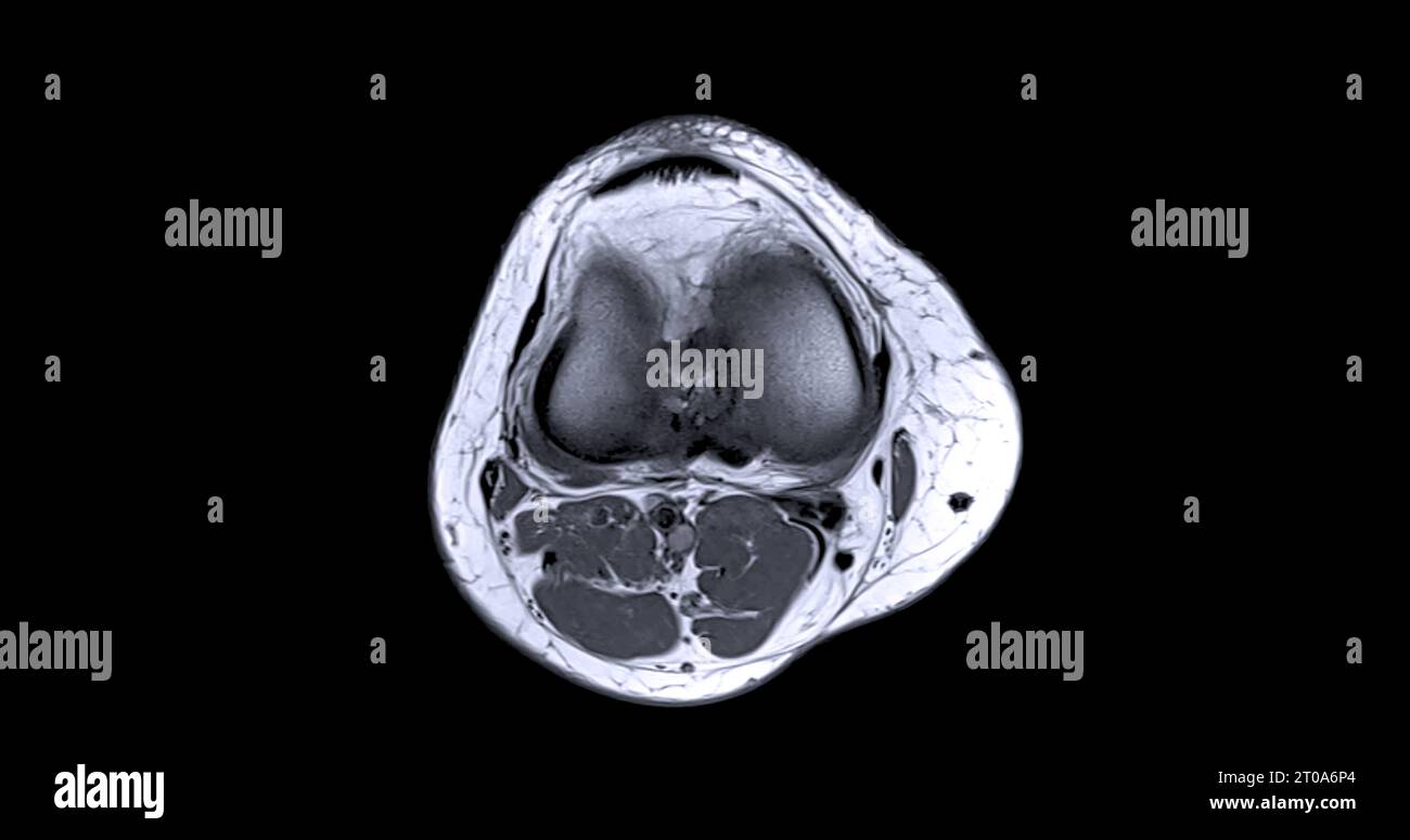 Magnetic resonance imaging or MRI of knee joint c for detect tear or ...