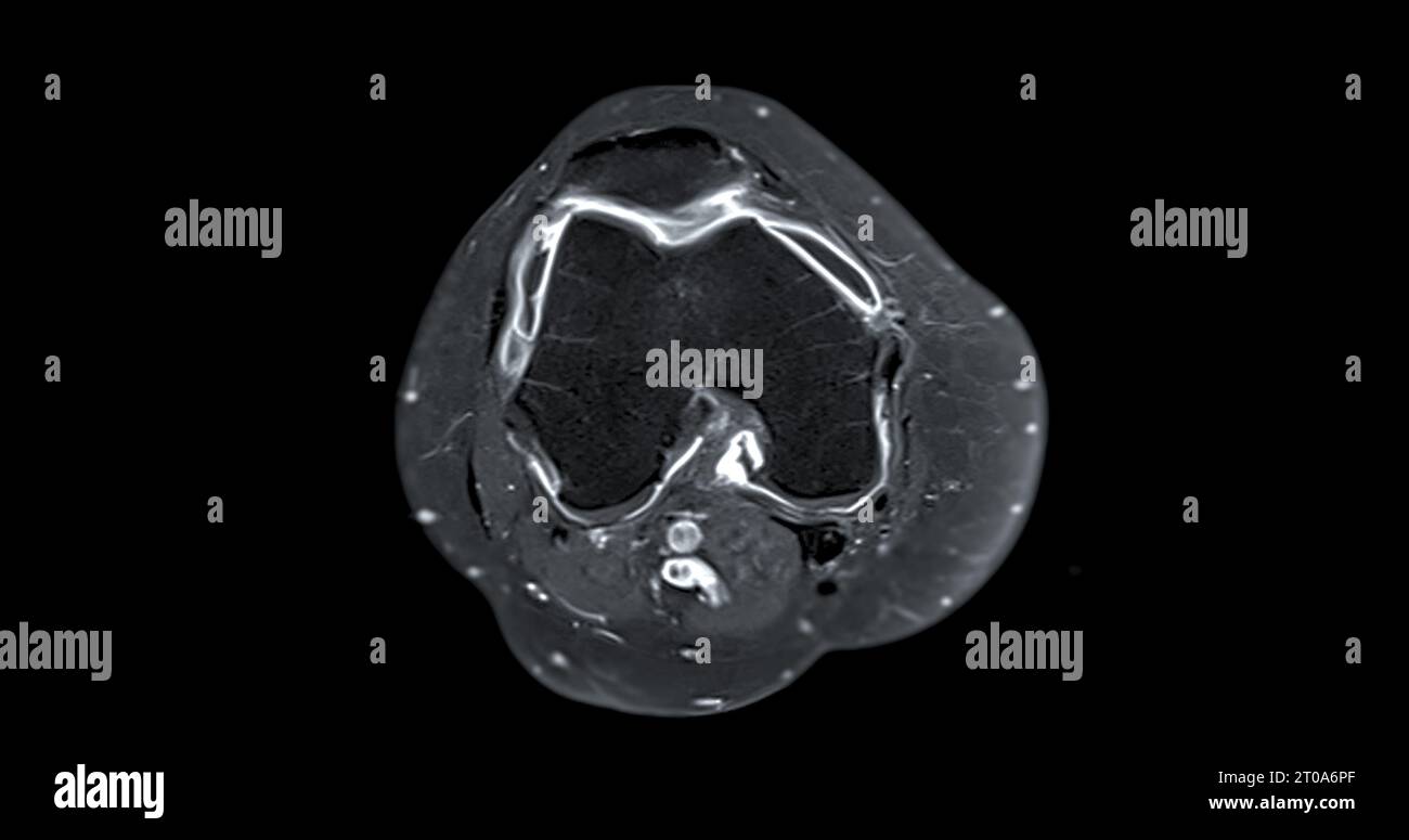 Magnetic resonance imaging or MRI of  knee joint c for detect tear or sprain of the anterior cruciate  ligament (ACL) Stock Photo