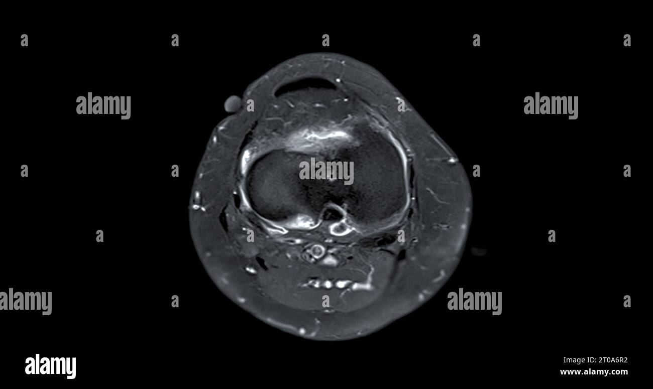 Magnetic resonance imaging or MRI of  knee joint c for detect tear or sprain of the anterior cruciate  ligament (ACL) Stock Photo