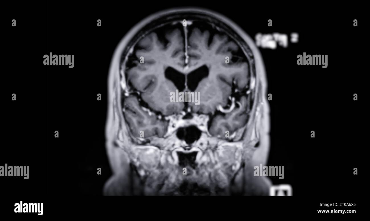 MRI scan of the brain for detect Brain diseases sush as stroke disease
