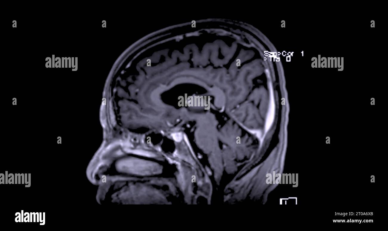 MRI scan of the brain for detect Brain diseases sush as stroke disease