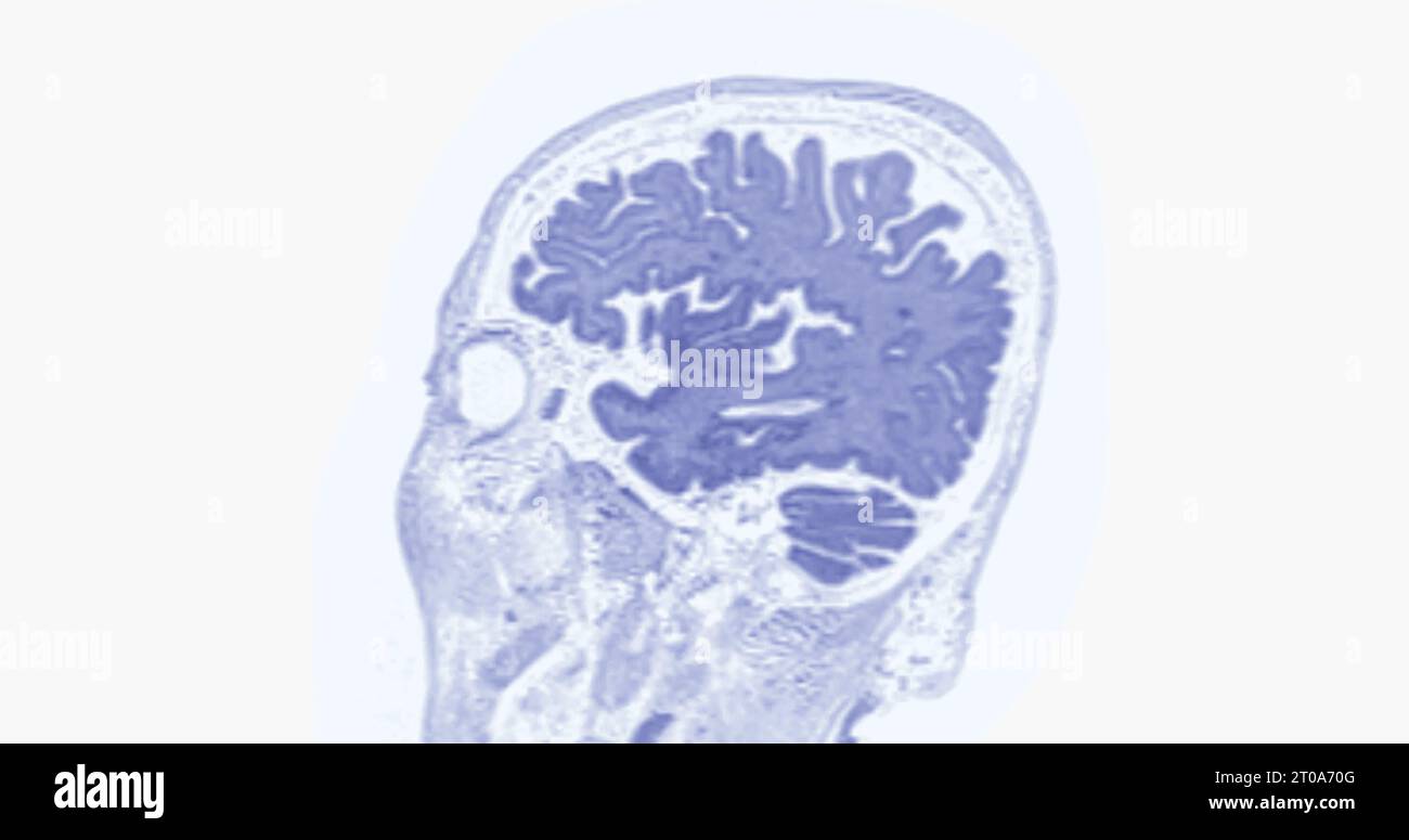 MRI scan of the brain for detect Brain diseases sush as stroke disease