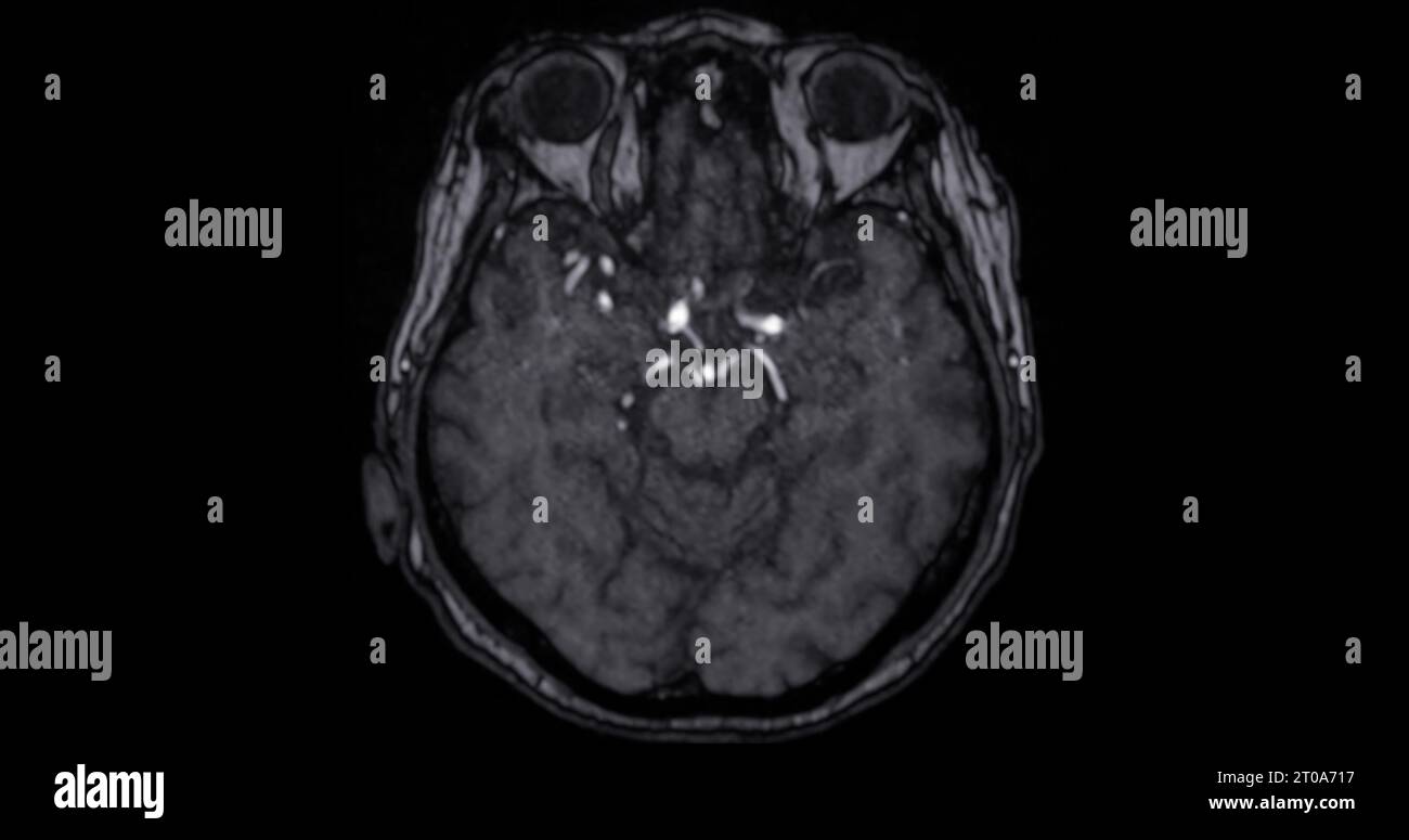 MRI scan of the brain for detect Brain diseases sush as stroke disease