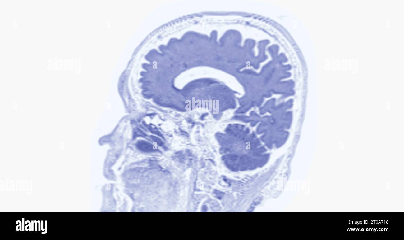 MRI scan of the brain for detect Brain diseases sush as stroke disease