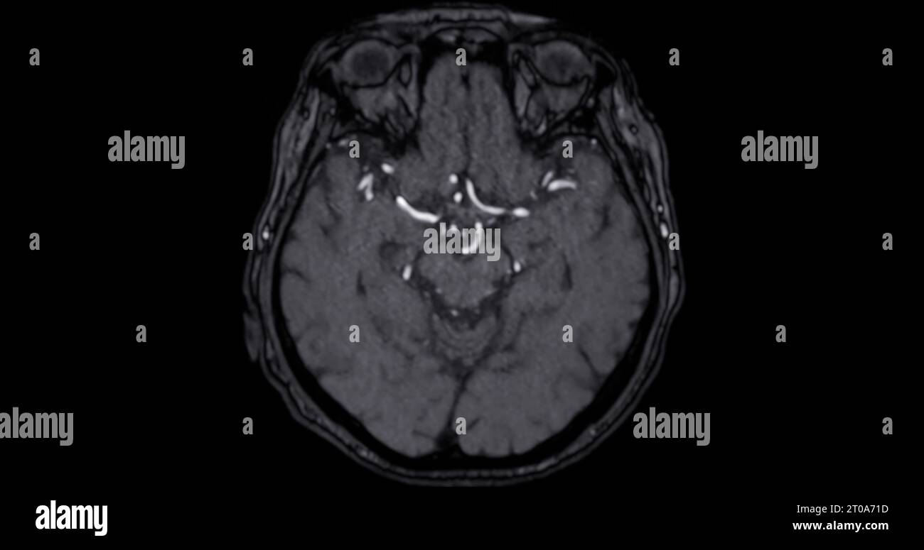 MRI scan of the brain for detect Brain diseases sush as stroke disease