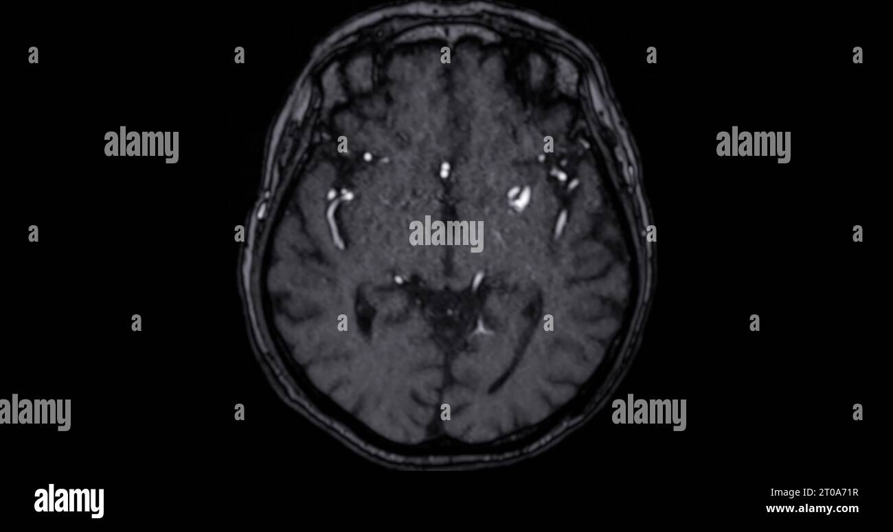 MRI scan of the  brain   for detect  Brain  diseases sush as stroke disease, Brain tumors and Infections. Stock Photo