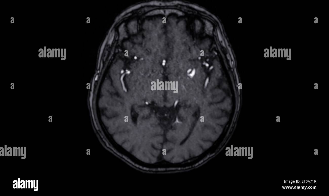 MRI scan of the brain for detect Brain diseases sush as stroke disease