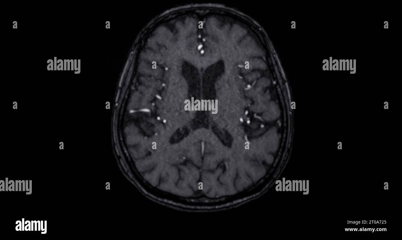 MRI scan of the brain for detect Brain diseases sush as stroke disease