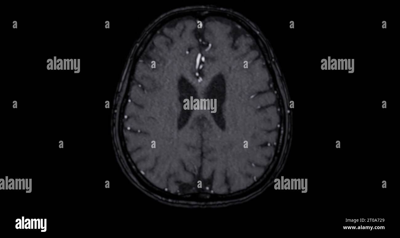 MRI scan of the  brain   for detect  Brain  diseases sush as stroke disease, Brain tumors and Infections. Stock Photo
