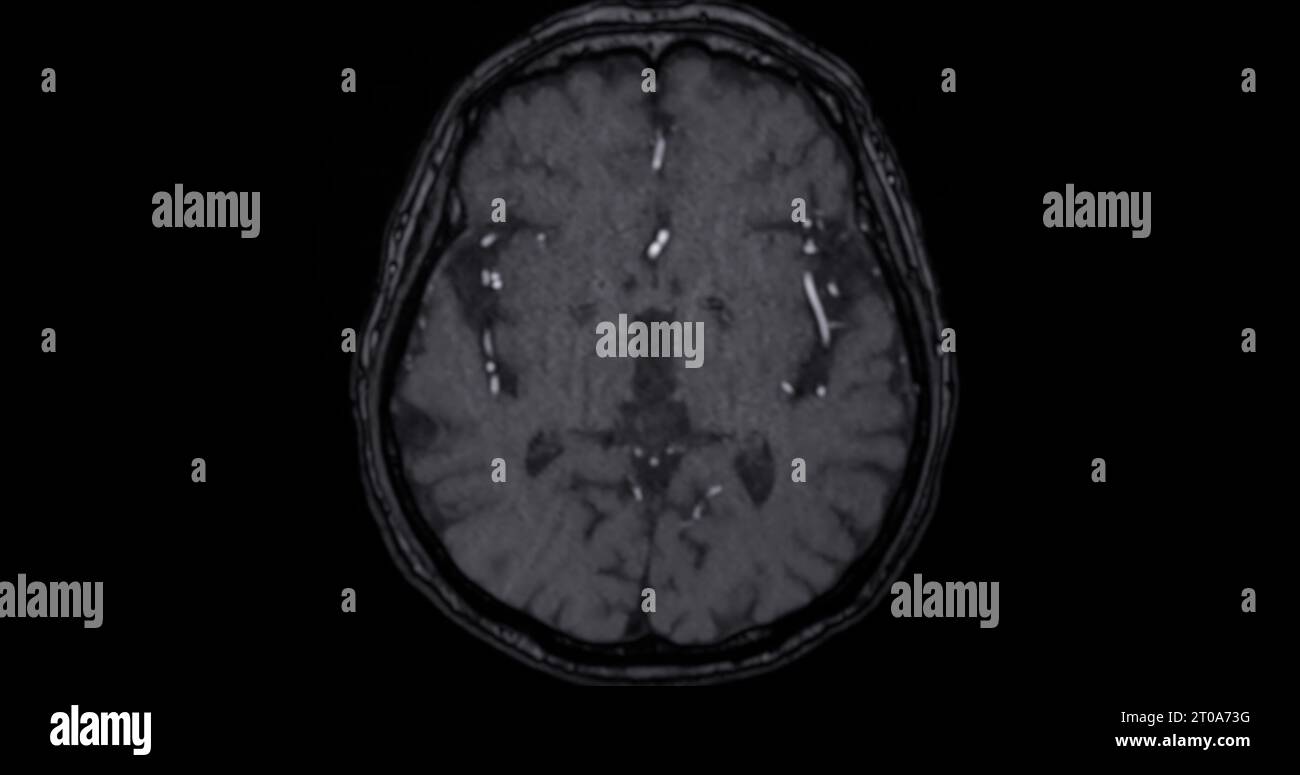 MRI scan of the brain for detect Brain diseases sush as stroke disease