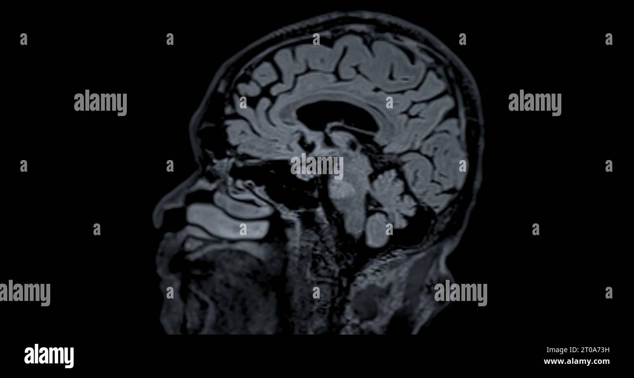 MRI scan of the  brain   for detect  Brain  diseases sush as stroke disease, Brain tumors and Infections. Stock Photo