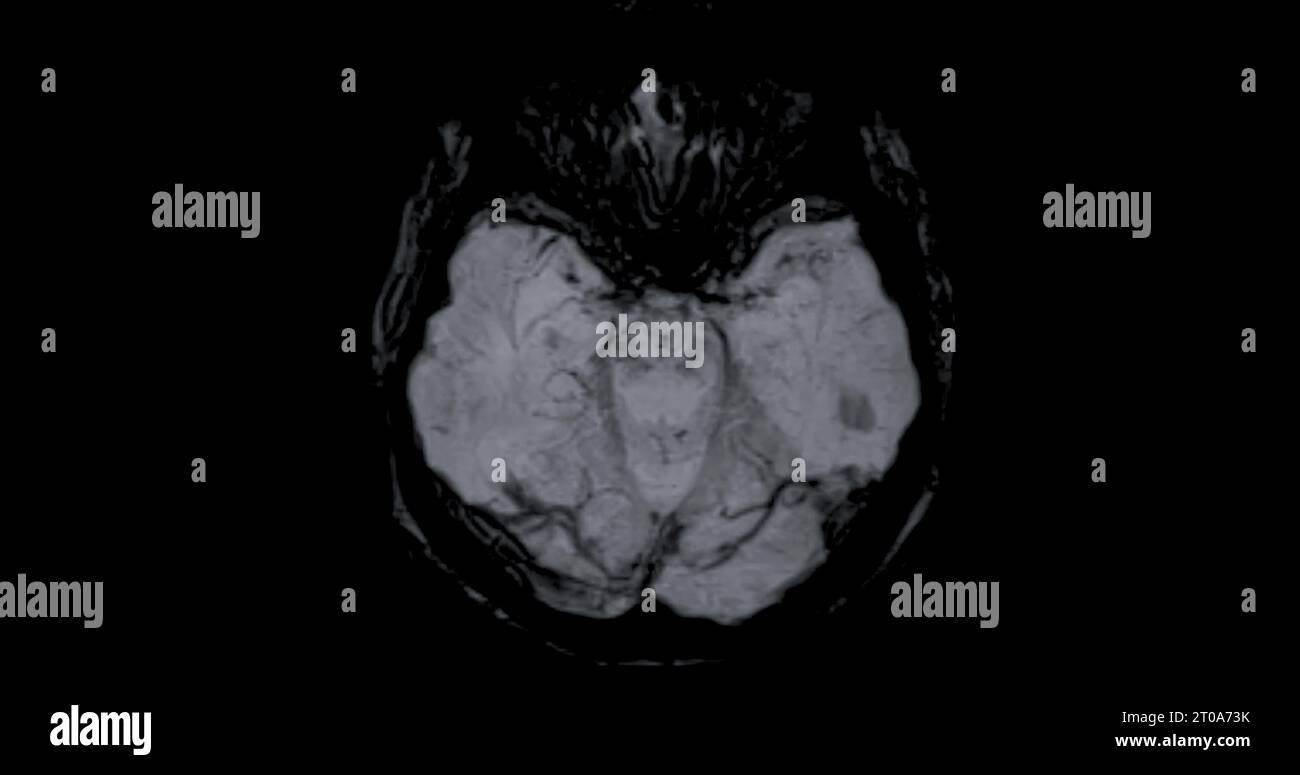 MRI scan of the brain for detect Brain diseases sush as stroke disease