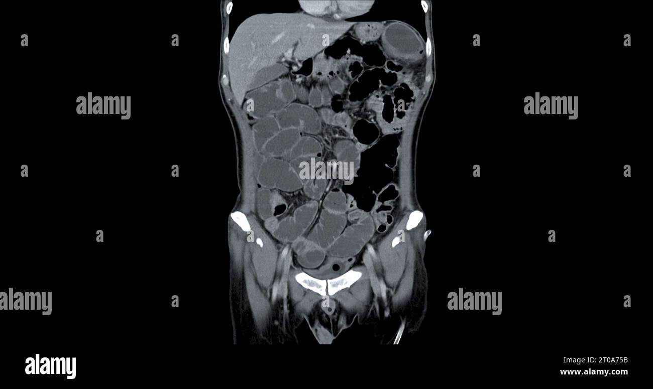 CT Chest and Abdomen with injection contrast media coronal view for diagnosis chest and