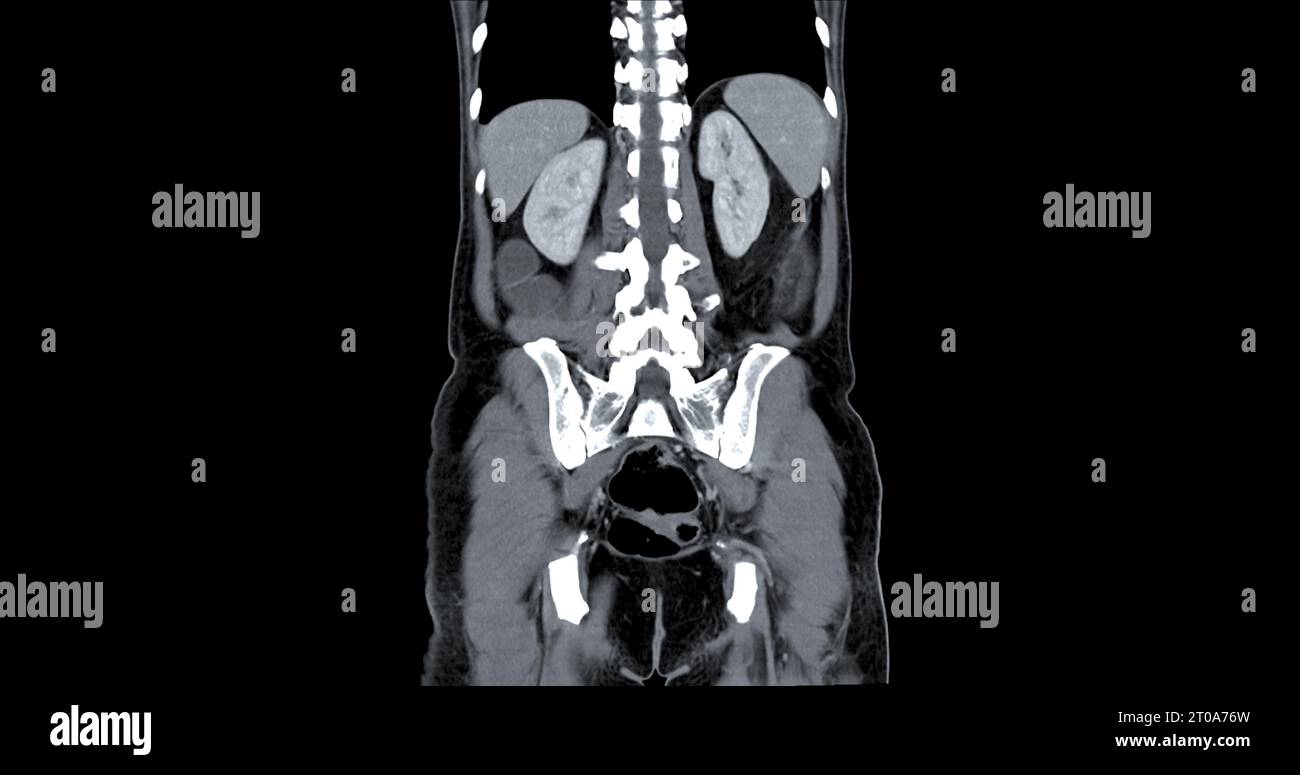 CT Chest and Abdomen with injection contrast media coronal view for diagnosis chest and