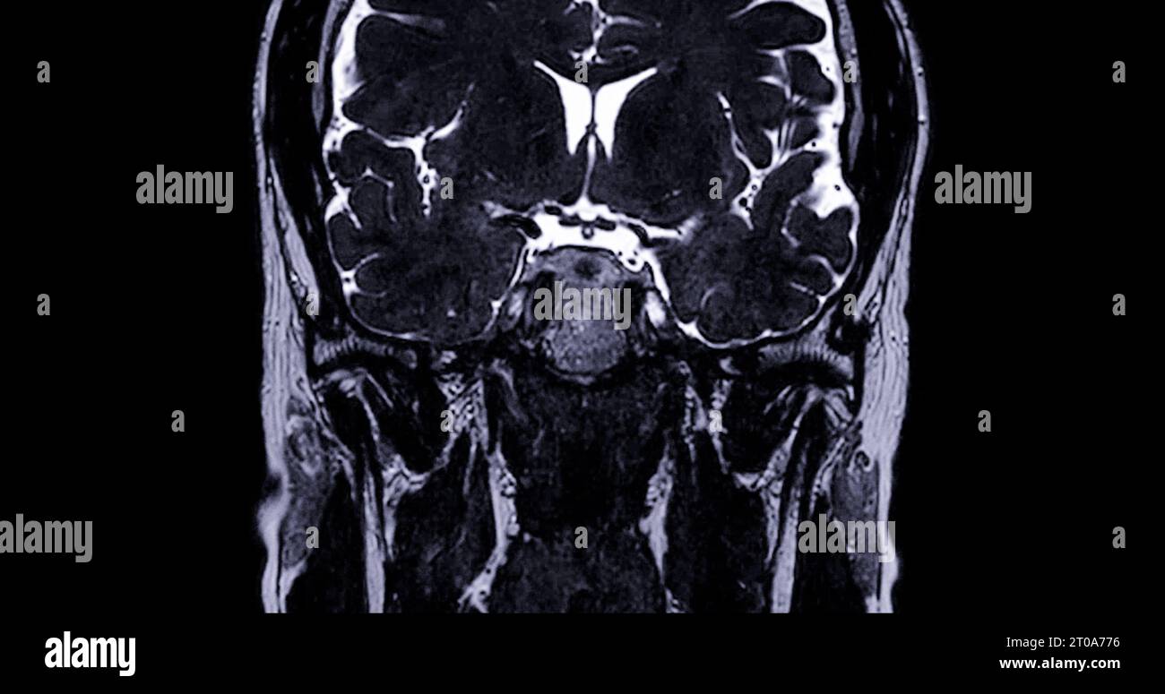 MRI scan of the internal auditory canal (IAC Stock Photo Alamy