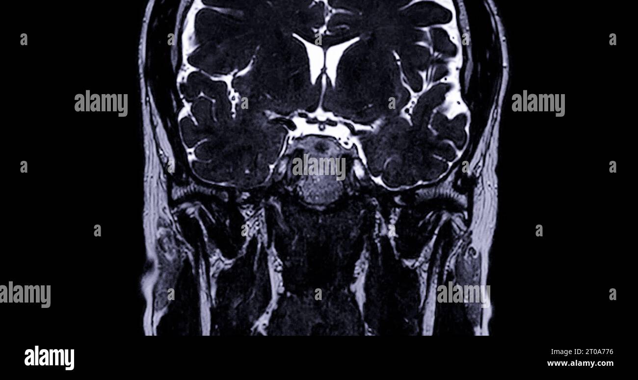 MRI scan of the internal auditory canal (IAC Stock Photo - Alamy