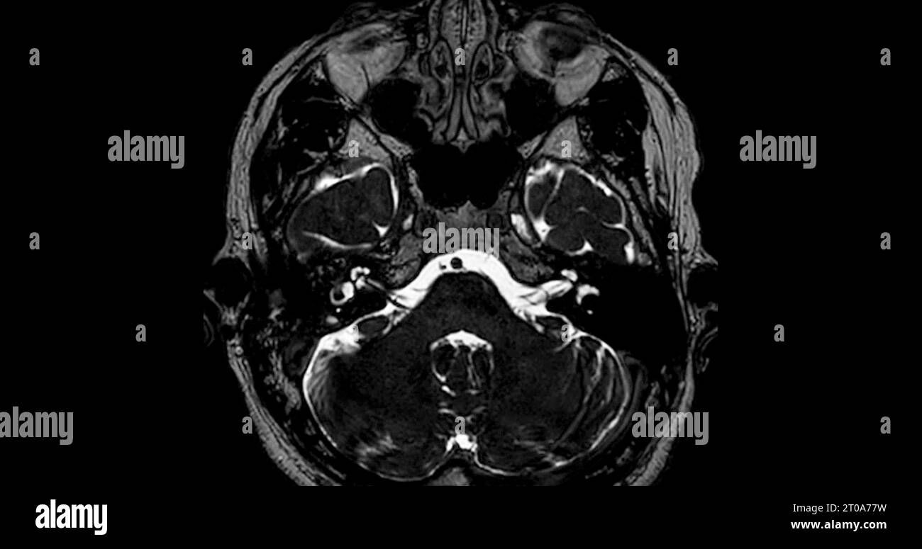 MRI scan of the internal auditory canal (IAC Stock Photo Alamy