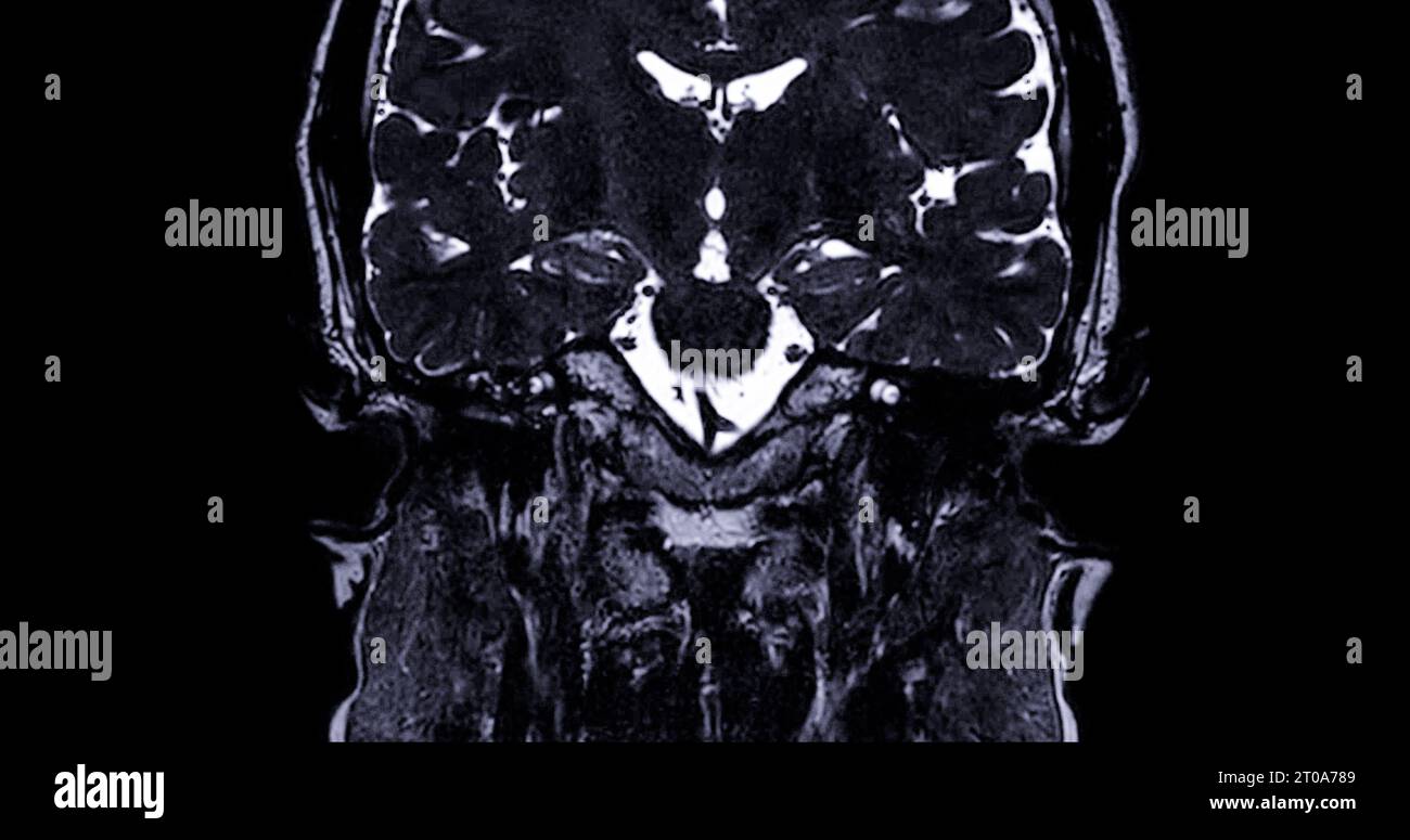 MRI scan of the internal auditory canal (IAC Stock Photo Alamy