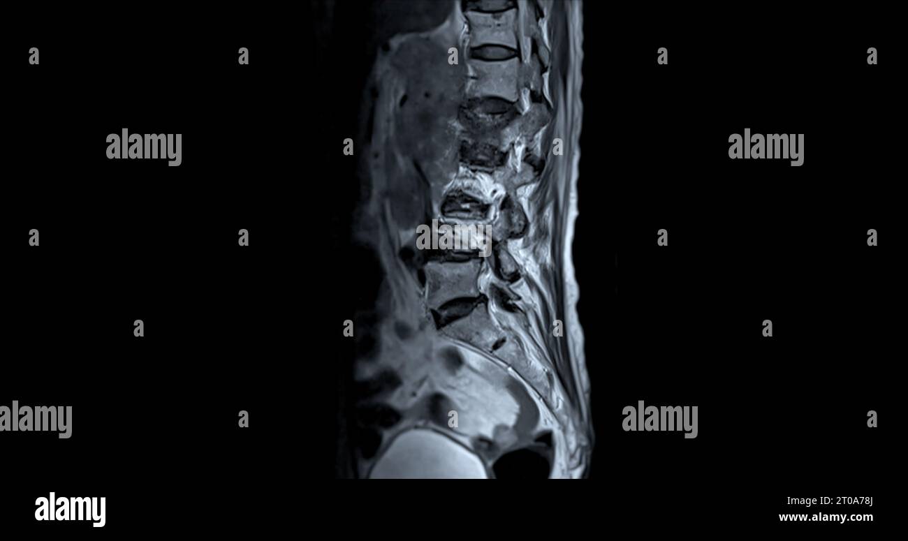 MRI L-S spine or lumbar spine sagittal T2W view  for diagnosis spinal cord compression. Stock Photo