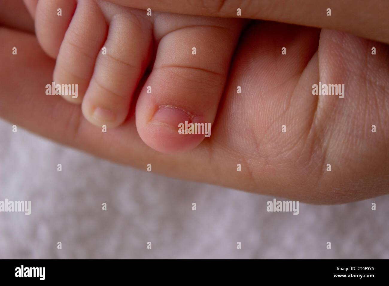 Series of painful finger nail skin infection with pus treatment Stock Photo  by ©Thamkc 259047140