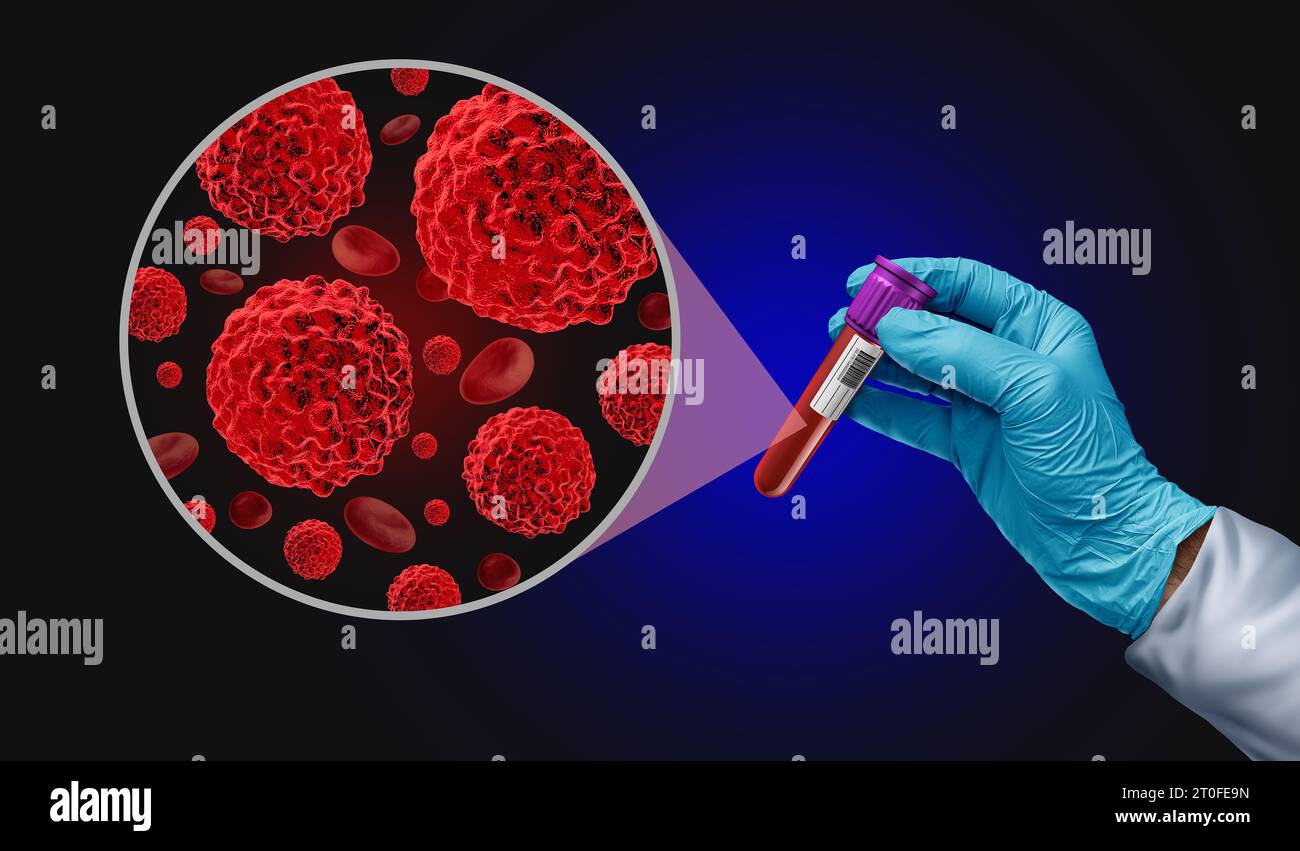 Blood Cancer screening Test as an Oncology medical diagnosis for tumor markers as a liquid biopsy for early detection with malignant cells to diagnose Stock Photo