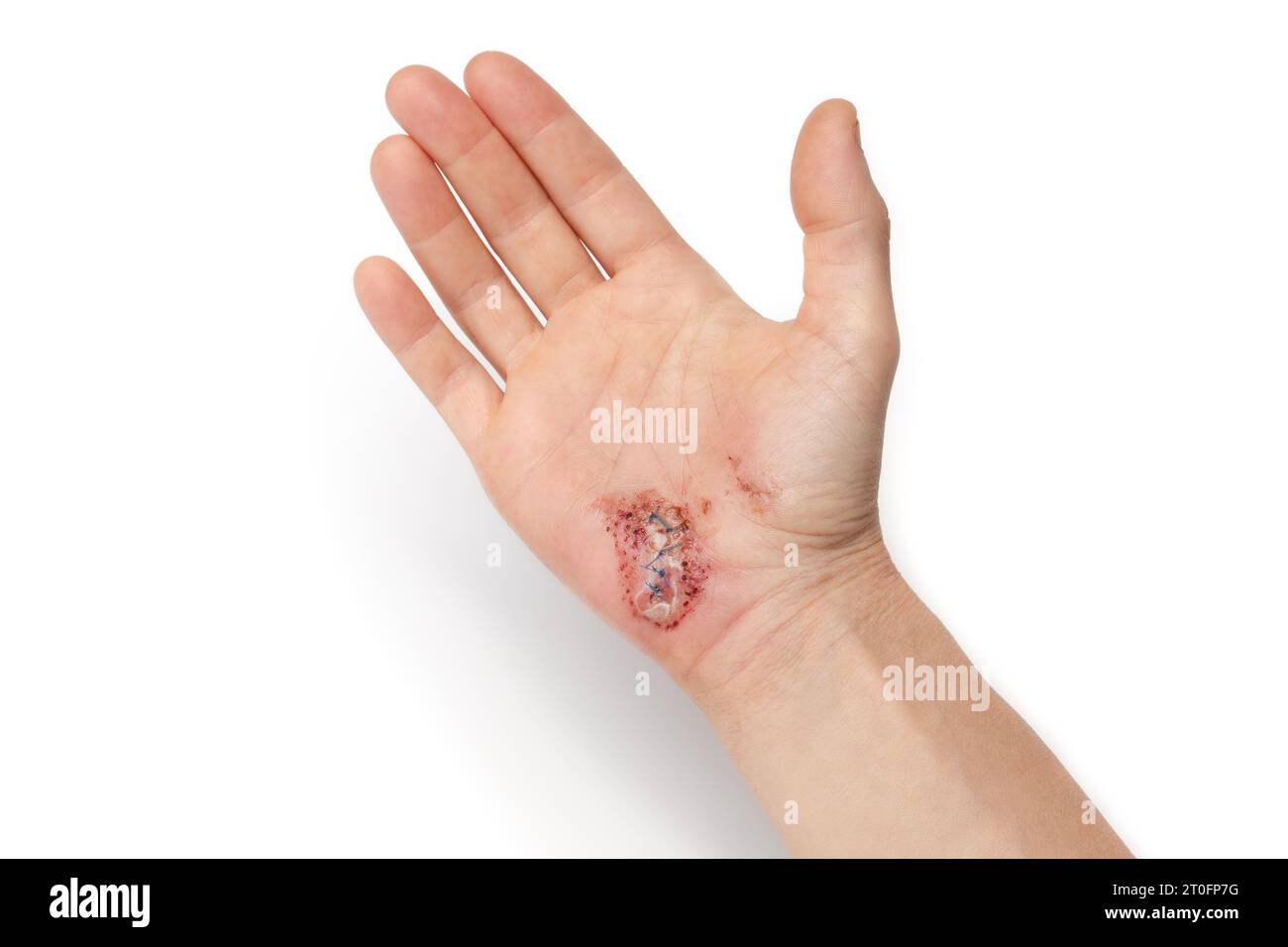 Hand with stiches or laceration after fall. Female hand with sutured wound in early healing stage. 3 days after injury was sutured. Swollen hand, yell Stock Photo
