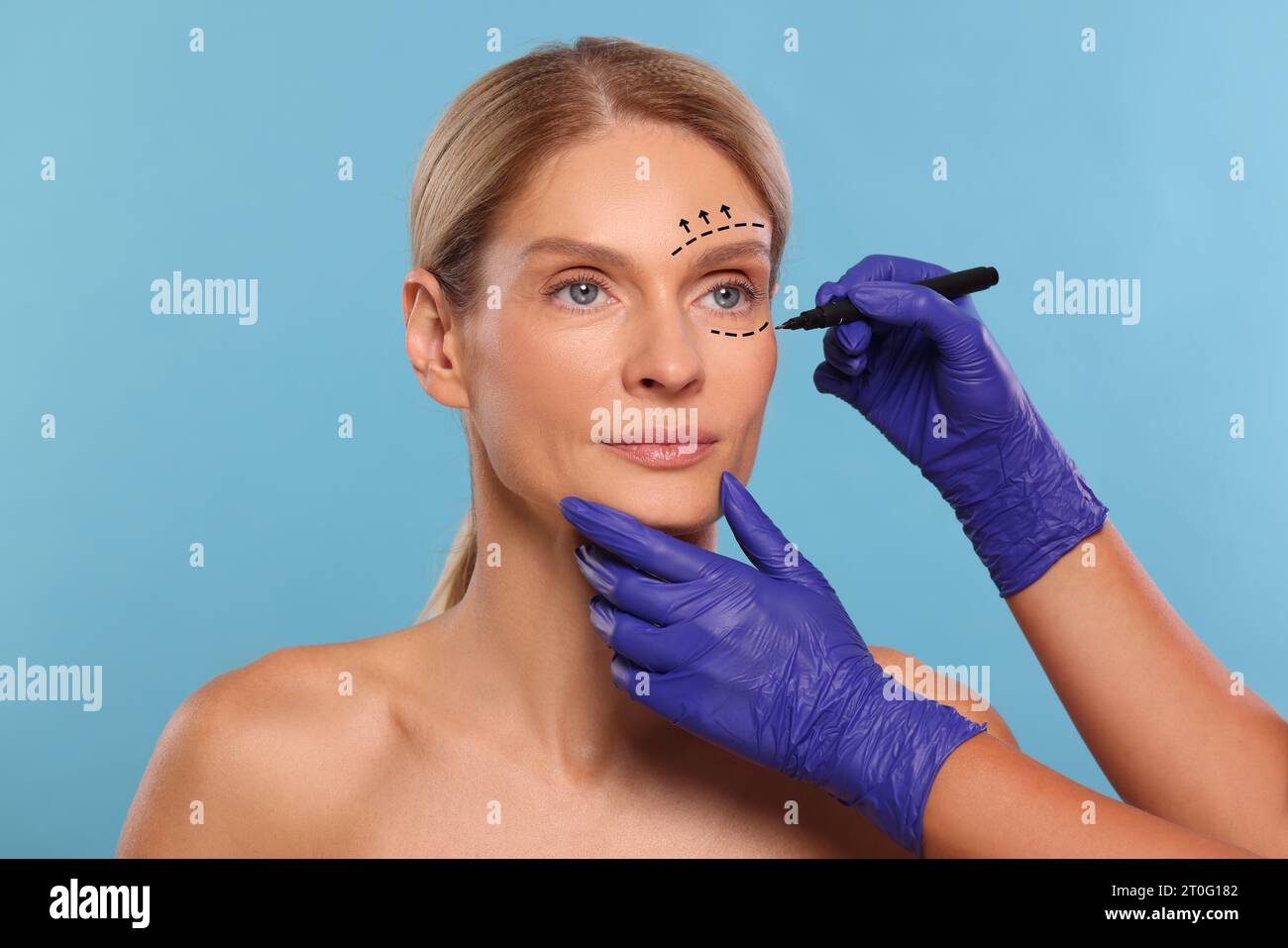 Woman Preparing For Cosmetic Surgery Light Blue Background Doctor Drawing Markings On Her Face 9904