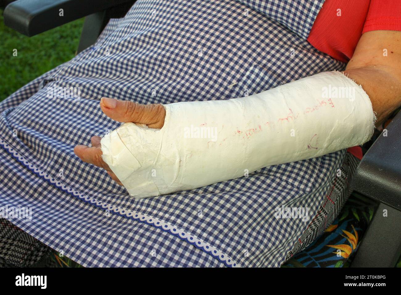 Picture Of An Arm In A Cast at Hunter Prevost blog