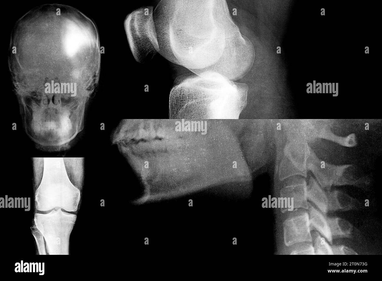 Set of x-ray body parts such as human knee, head, jaw and teeth, group of x-ray images for diagnosing different types of diseases, skeleton Stock Photo