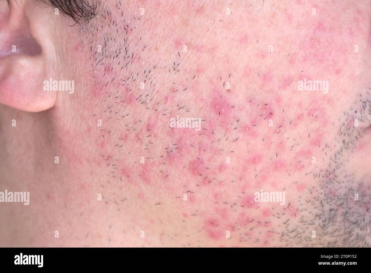 Dermatitis on man face. Eczema close up. Stock Photo